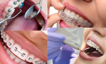 Diş Teli Tedavisi: Daha Sağlıklı ve Estetik Bir Gülüş İçin